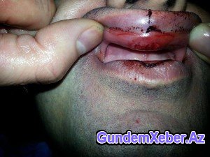 Gənc alimi vəhşicəsinə döyən şəxs hansı vəzifəli polisin oğludur? - Fotolar (Özəl)