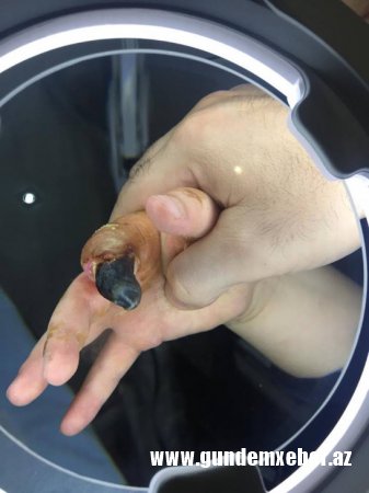 Plastik cərrah Vaqif Qələndərli 8 yaşlı uşağı şikəst edib? – (FOTOLAR)